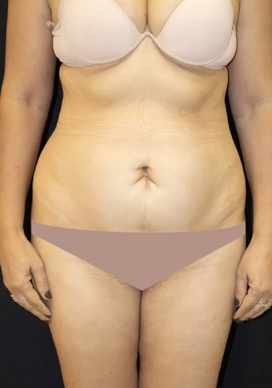 Abdominoplastia, antes