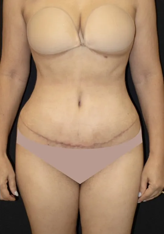 Abdominoplastia, depois